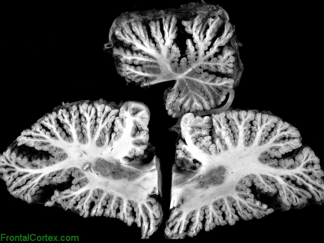 Cerebellar Sclerosis, Sagittal sections